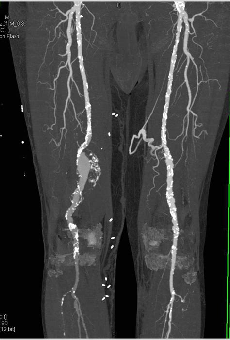 Dual Energy Cta Runoff With Peripheral Vascular Disease Vascular Case