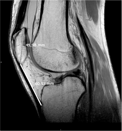 Sagittal Patella Fracture