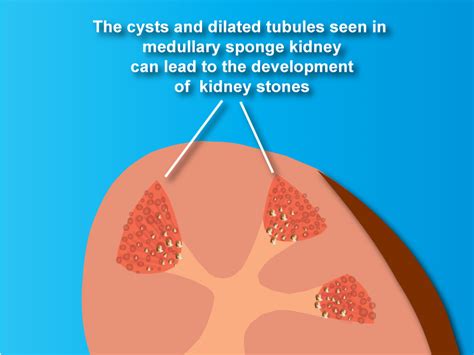 What Is Medullary Sponge Kidney