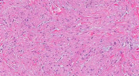 Leiomyoma of the skin | Ottawa Atlas of Pathology