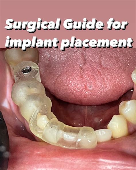 Why We Place Implants With A Surguical Guides Dental Implant Studio