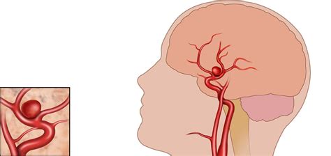 Aneurysma Was Ist Das Aneurysma Ursachen Symptome Diagnose Behandlung