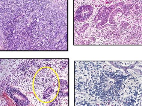 Germ Cell Tumors Of Ovary