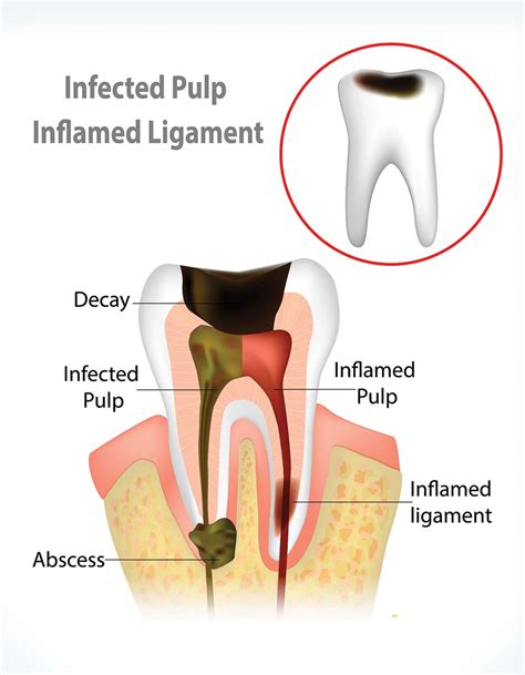 Root Canal Therapy Randolph NJ | Dickerson Dental Group