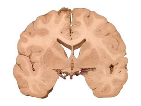 Neuroanatomy Coronal Section Tuber Cinerium Diagram Quizlet