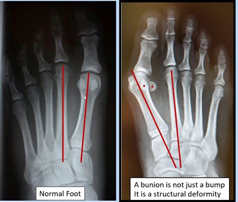 Metatarsus Adductus Xray