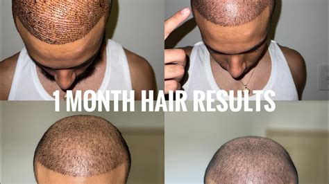 1 Month Hair Transplant Results From Asli Tarcan For 5500 Grafts Youtube