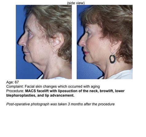 Facelift Surgery Uf Health Plastic Surgery And Aesthetics Center Uf