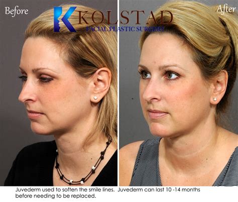 Soften Smile Lines with Juvederm Fillers in La Jolla Before & After ...