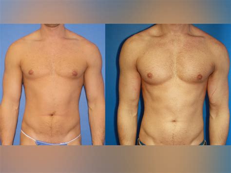 5 Plastic Surgeries That Make Fit Guys Look More Muscular Men S Journal