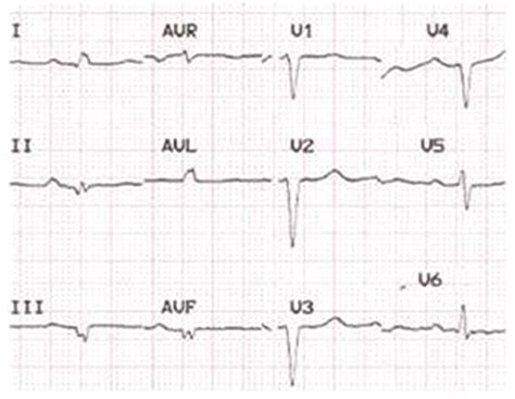 Ecg Of A Patient With Cardiac Al Amyloidosis Showing Small Qrs Voltages