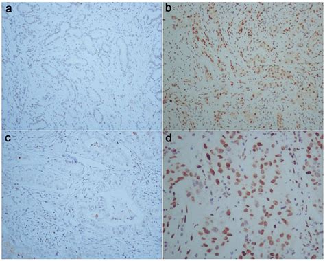 Pstat Expression In Human Gallbladder Carcinoma First Row A B