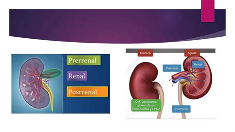 Lesion Renal Aguda Pptx