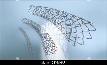 D Illustration Of Stent Implantation For Supporting Blood Circulation