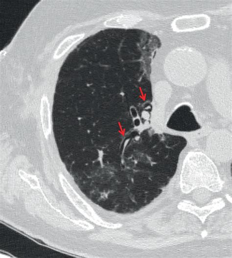 Initial axial chest CT two weeks prior shows interstitial emphysema... | Download Scientific Diagram