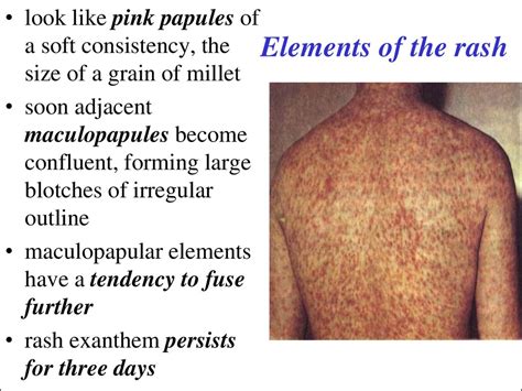 The Diseases With The Exanthemas Syndromes презентация онлайн