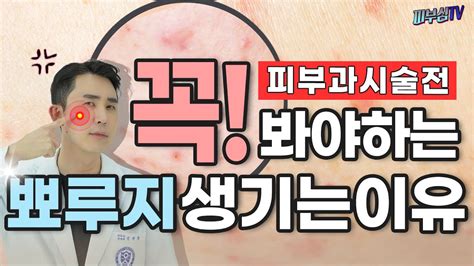 피부과시술전 꼭 봐야하는 뾰루지 생기는 이유 피부과전문의 피부심 Youtube