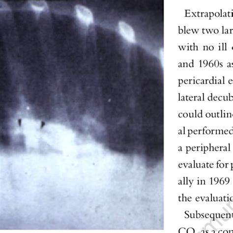 Left lateral decubitus chest x-ray after the administration of ...