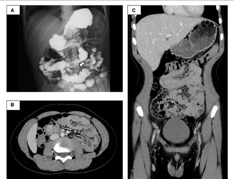 Figure 2 From Gastrointestinal Bleeding After Endoscopic Mucosal