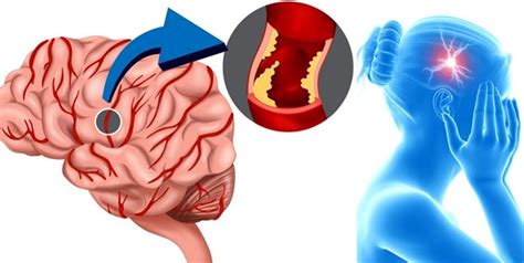 Retrocerebellar Arachnoid Cyst Common Information Dangerous Or Not