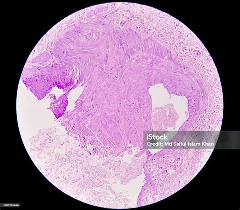 Photomicrograph Prepatellar Region Histology Showing Bursitis Acute Or ...