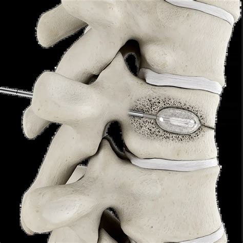 Spine Fracture for Greenwood Village and Windsor, CO | RIA Endovascular ...