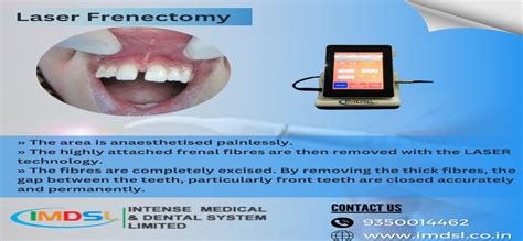 Dental Practice With Laser Frenectomy