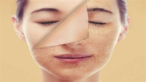 natural remedies  patchy skin boldskycom