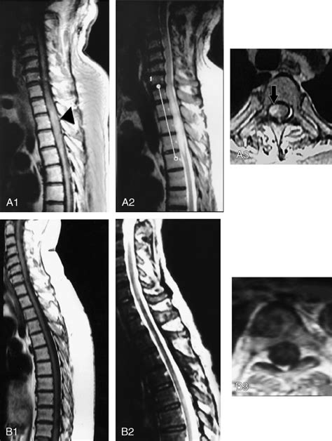 Mri Of Patient A Sagittal T Weighted Image Of The Dorsal Spine