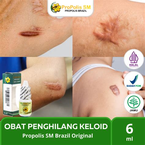 Propolis Asli Original Obat Keloid Menonjol Tahunan Bekas Luka