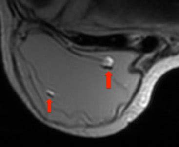 Chemical shift artifact - Questions and Answers in MRI