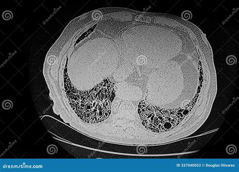 CT SCAN of Idiopathic Pulmonary Fibrosis Stock Illustration ...