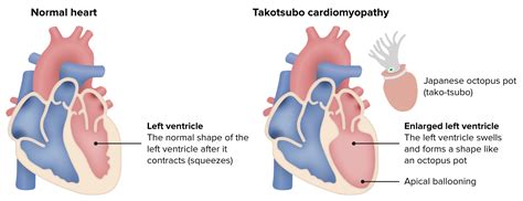 Takotsubo Cardiomyopathy Symptoms