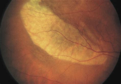 Tear Of The Retinal Pigment Epithelium And Serous Retinal Detachment In