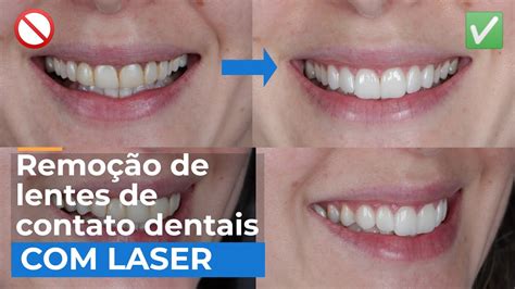 Laser Para Remover Facetas E Lentes De Contato Dental De Porcelana E