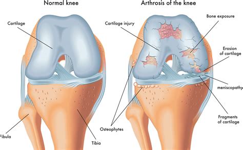 Chondral Lining Damage Injury Knee Hip And Shoulder