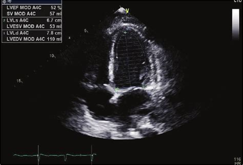 Echocardiogram Showing Left Ventricular Hypertrophy A