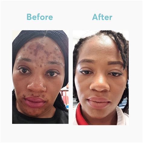 Bentonite Clay Mask Before And After