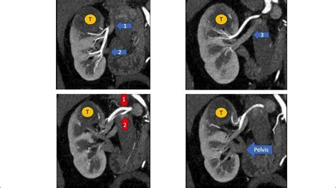 Robot Assisted Partial Nephrectomy Rapn With Complex Vascular Anatomy