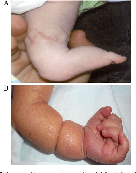 Amniotic Band Syndrome Arm