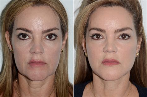 Lifting Facial Facelift Fotos Coral Gables Fl Paciente