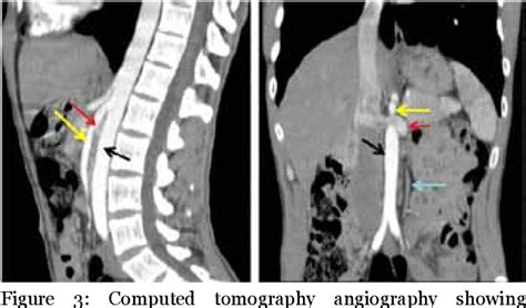 Figure 1 From Spontaneous Spermatic Vein Thrombosis As A Circumstance