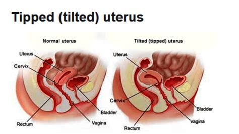 Anteverted Uterus Position Fertility Is It Normal 41 Off