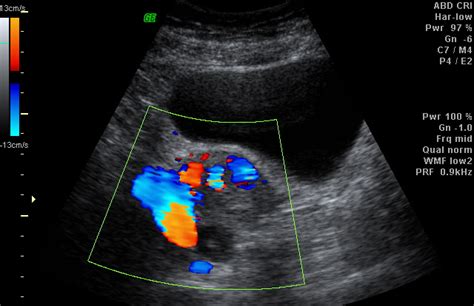 Radiodiagnosis Imaging Is Amazing Interesting Cases Uterine