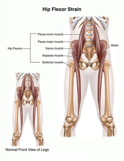 Hip Flexor Strain Physiodiary