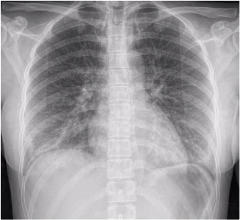 Anterior Posterior AP Portable Chest Radiograph On Admission Showing