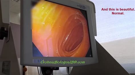 Ileoscopy Youtube