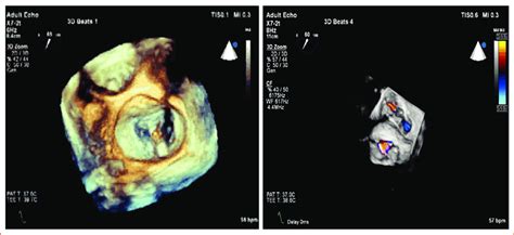 Mitraclip Implantation Download Scientific Diagram