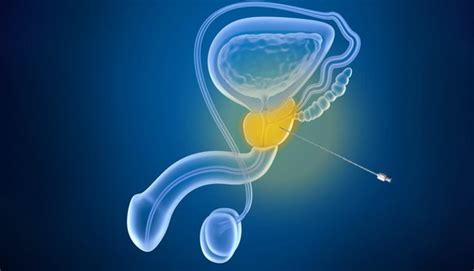 Como É Feito A Biopsia Da Prostata - Biopsia De Prostata Por Ultrassom Transretal