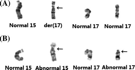 G‐banded Chromosomes 15 And 17 From The Fetus A And The Father B Download Scientific Diagram